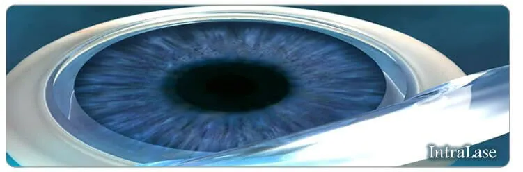 lasik- eye-surgery-Laser-Flap-Formation